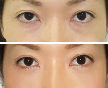 有什么方法可以去眼袋吗 20121218104720941.jpg