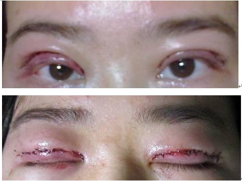 恢复超快的肿眼泡手术更新中——效果还是灰常满意滴