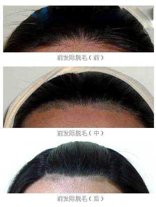 激光脱发际线案例对比图