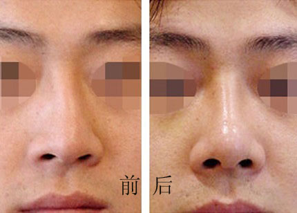 歪鼻矫正手术效果图片