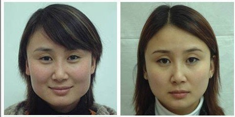 颧骨整形手术对比图