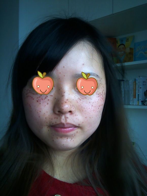 下面这张是我刚做好激光祛斑的时候的照片