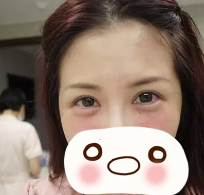 玻尿酸丰卧蚕后 真的变成了娇媚的小女人
