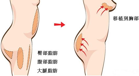 炫美网 整形中心 胸部整形 自体脂肪隆胸 > 正文 首先选择抽取脂肪的