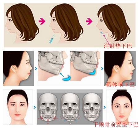长沙瑞澜整形医院垫下巴贵么