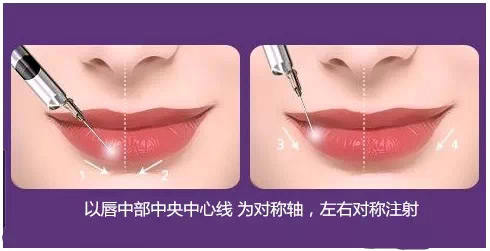 玻尿酸丰唇和自体脂肪丰唇有什么区别 - 丰唇手术 - 炫美网