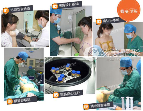 南阳维多利亚自体脂肪隆胸前后对比案例