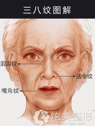 什么是三八纹包括泪沟,嘴角纹,法令纹