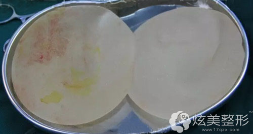 修复隆胸失败手术找深圳希思李俊医生还您圆润丰满乳房