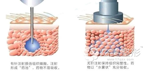 微整医生丁小邦:无针水光有效果吗?和有针水光区别是什么