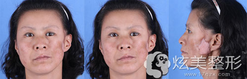 大连爱德丽格王志军和张晨奥美定取出修复拯救半脸妈妈