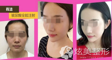 玻尿酸注射案例河南整形