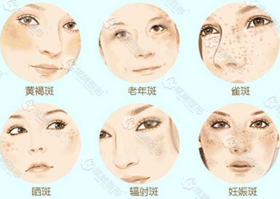 才能算雀斑 雀斑是因为体质性色素失调症导致的散布在脸上的褐色斑点