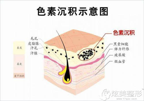 这种黑眼圈很难淡化;后天性主要包含卸妆不致使化妆品的色素颗粒渗透