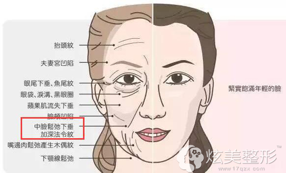 北医三院毕洪森医生讲法令纹分类型治疗效果更好