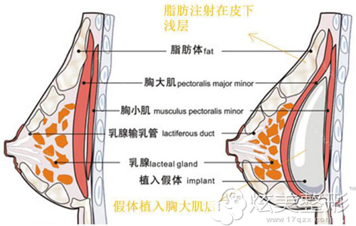 广元朗睿假体 自体脂肪复合隆胸案例术后效果更自然