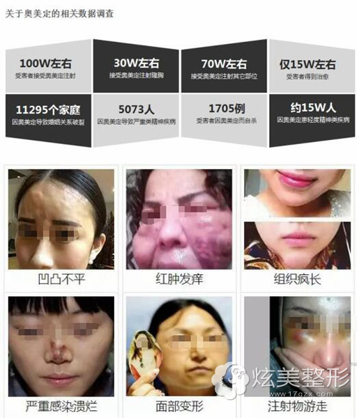 tips:《 怎么区别奥美定和玻尿酸 》