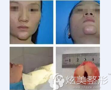 北京八大处辛敏强医生能做下巴注射奥美定取出吗