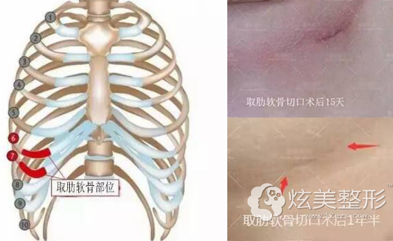 求问上海九院李青峰异体肋软骨隆鼻靠谱吗会排异吗