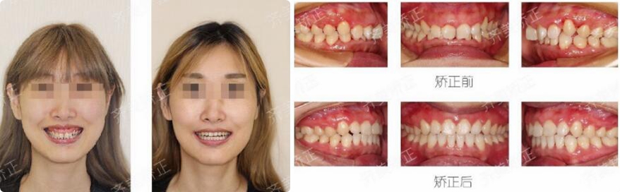 多个案例见证上海齐美口腔医院牙齿矫正效果不反弹