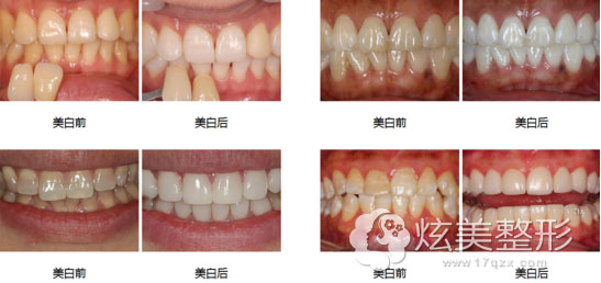 牙齿又黄又黑到合肥贝杰口腔做冷光美白有效果吗
