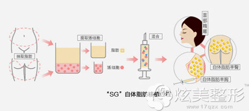 找广州洛萱周绍龙做自体脂肪填充有案例效果吗?价格贵不整形案例 广