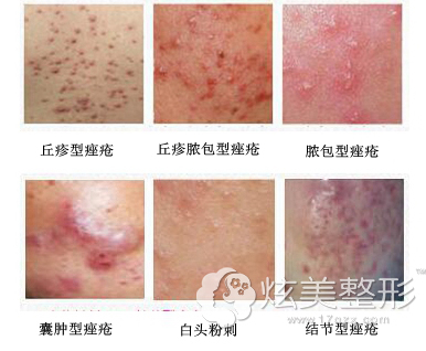 痘痘常见的不同类型