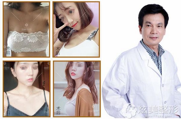 林沸腾隆胸案例对比