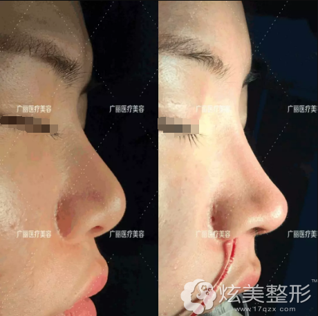 肋软骨隆鼻价格多少?王英明院长给你看8千元的术后效果