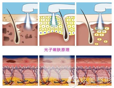 光子嫩肤工作原理