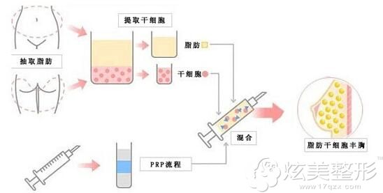 在福州做自体脂肪丰胸手术选台江医院更好且附带隆胸案例