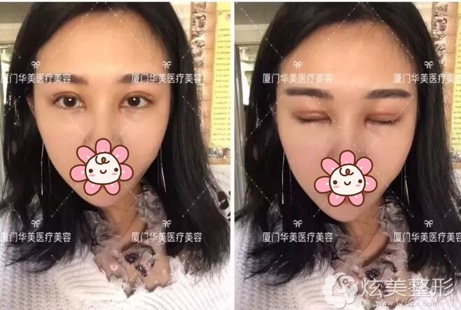 无神呆滞内双眼到厦门华美割双眼皮变灵动无痕大眼