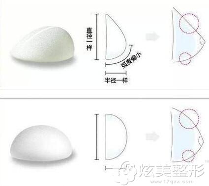圆形假体和水滴形假体