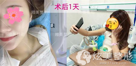 20岁未婚的她到衡阳雅美亲测娜绮丽假体隆胸术后手感自然