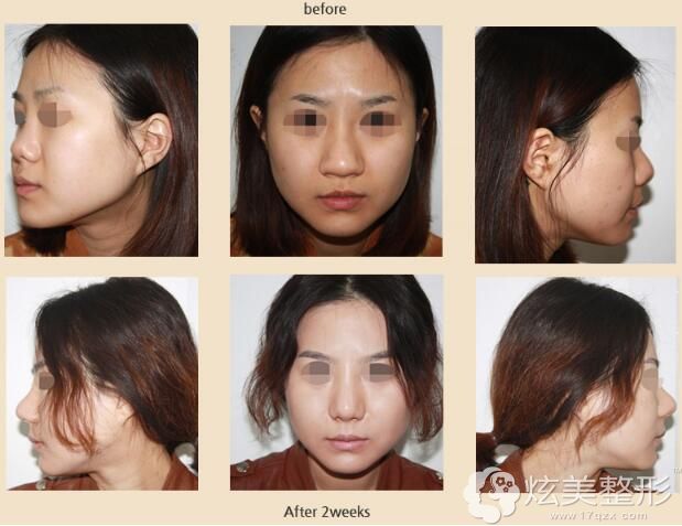 福鼻歪鼻朝天鼻驼峰鼻你的鼻缺陷在韩国眼鼻美人能解决