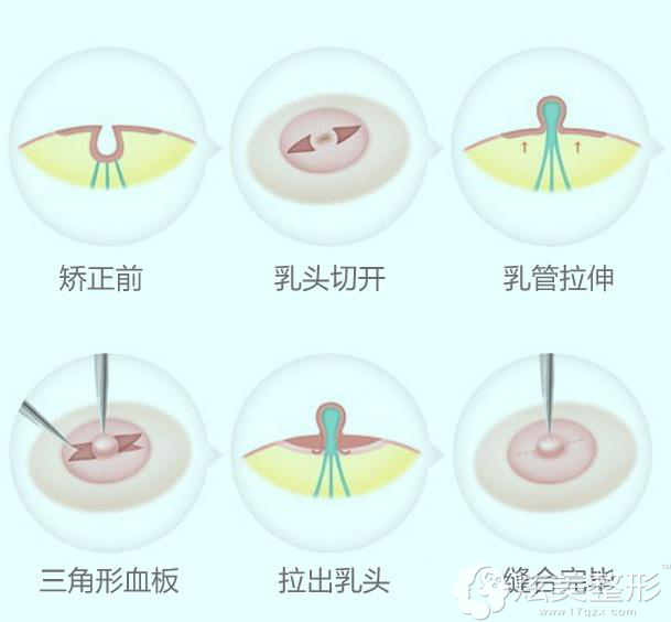 每日数次牵拉联系,时间长了,乳头自然逐渐向外凸起.