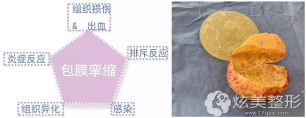 2级包膜挛缩必须手术吗