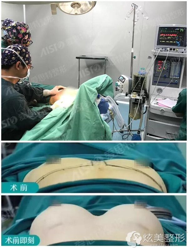 娜绮丽中高全凸的假体 脂肪复合丰胸真实经历