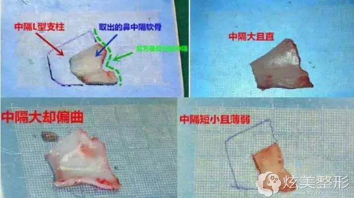 争议性较大的鼻中隔软骨垫鼻尖做鼻综合整形老了会塌陷吗