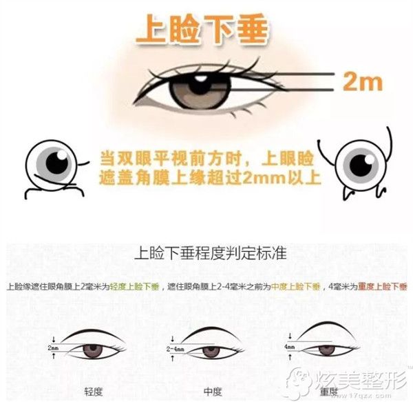 上睑下垂的不同程度