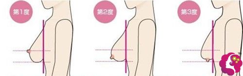 乳房下垂做双环上提矫正术后6个月出现褶皱感该怎么修复