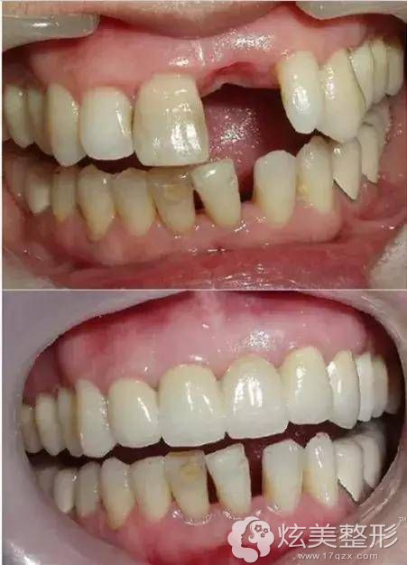 长沙美奥良心牙医公开:门牙种植牙需要多少钱一颗