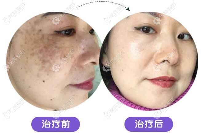 斑友问:蜂巢皮秒祛斑效果明显的东莞科医能祛斑要多少钱