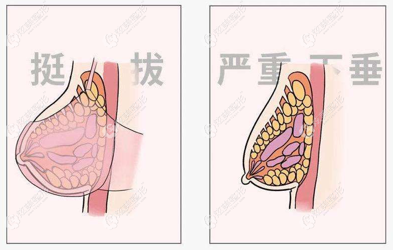 有谁做过乳房下垂矫正北京韩啸人工韧带提升得多少钱