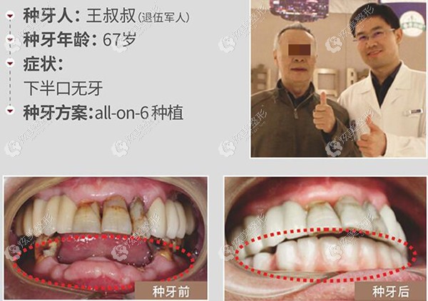 72岁马叔看到南宁柏乐做67岁半口种植牙效果后也决定手术