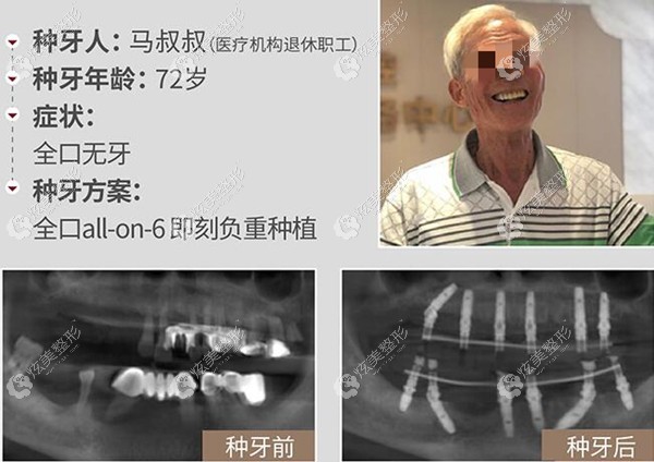 柏乐小日记72岁马叔看完67岁半口种植牙效果后来做全口种植啦