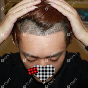陈海亮医生种植头发2000单位面积效果图用微针植发技术挺不错