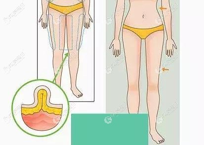 南京艺星陈孝闯医生的抽脂技术好且做吸脂瘦腿的价格亲民