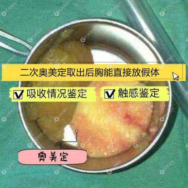 做二次取出奥美定后经过判断是可以一起放假体改善凹陷胸