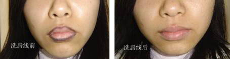 纹唇的危害纹唇后注意事项